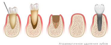 Атравматичное удаление зубов