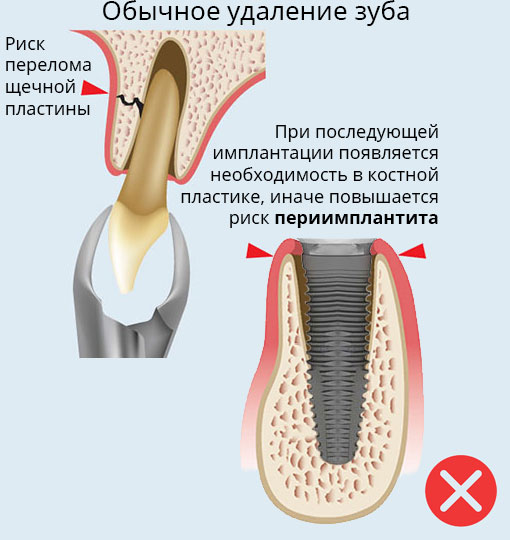 Атравматичное удаление зубов обычное травматичное удаление зубов