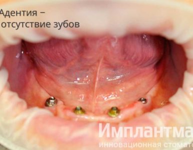 Адентия отсутствие зубов