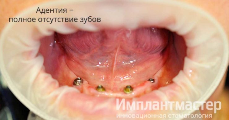Адентия отсутствие зубов