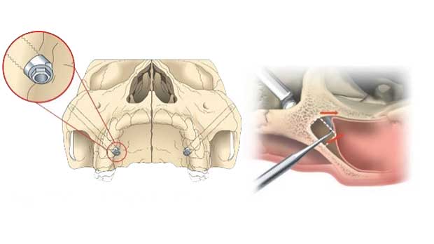 Скуловая имплантация зубов подряд на верхней челюсти