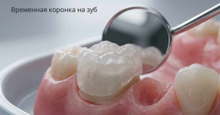Временная коронка на зуб: что нужно знать каждому пациенту