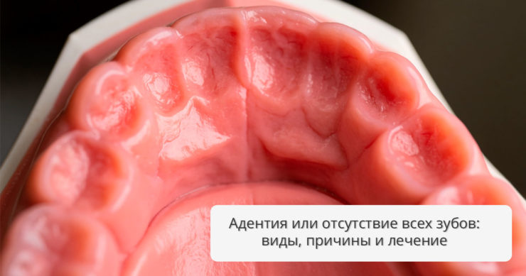 Адентия или отсутствие всех зубов: виды, причины и лечение