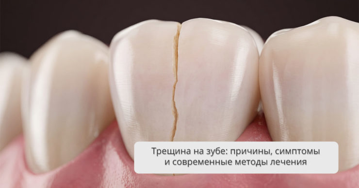 Трещина на зубе: причины, симптомы и современные методы лечения