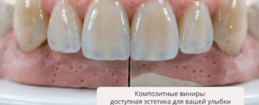 Композитные виниры: доступная эстетика для вашей улыбки