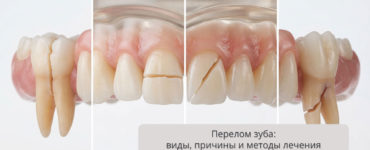 Перелом зуба: виды, причины и современные методы лечения