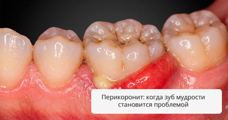 Перикоронит: когда прорезывание зубов мудрости становится проблемой