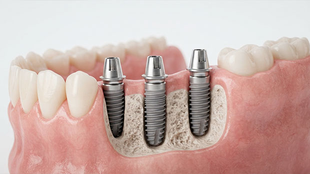 3 импланта на боковые задние жевательные зубы