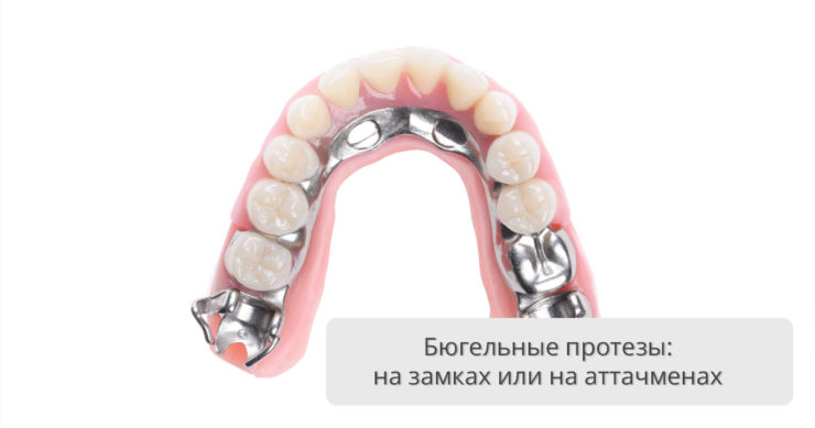 Бюгельные протезы на замках (аттачменах)