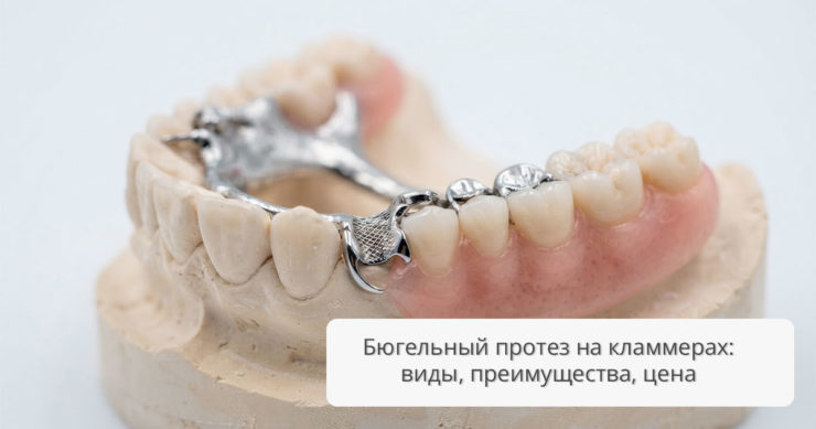 Бюгельный протез на кламмерах: виды, преимущества, цена