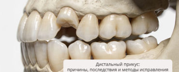 Дистальный прикус: причины, последствия и методы исправления