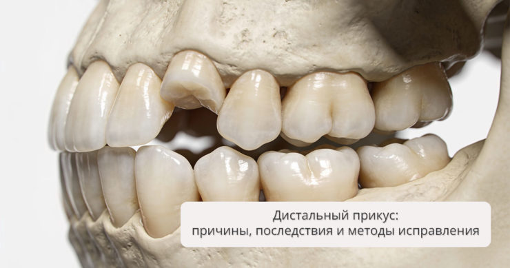 Дистальный прикус: причины, последствия и методы исправления