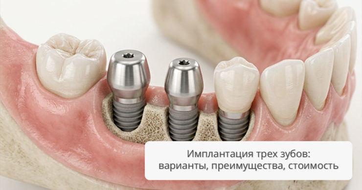 Имплантация трех зубов: варианты, преимущества, стоимость