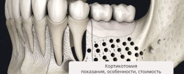 Кортикотомия: показания, особенности выполнения, стоимость