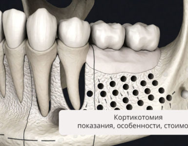 Кортикотомия: показания, особенности выполнения, стоимость