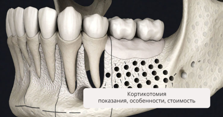 Кортикотомия: показания, особенности выполнения, стоимость