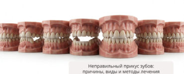 Неправильный прикус зубов: причины, виды и современные методы лечения