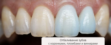 Отбеливание зубов с коронками и пломбами: методы и результат