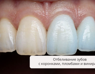 Отбеливание зубов с коронками и пломбами: методы и результат