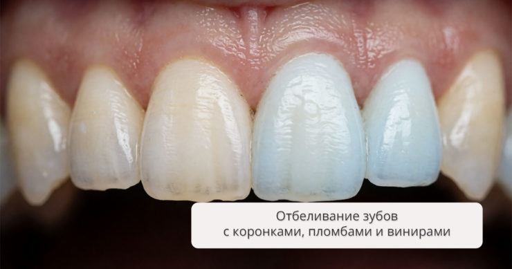 Отбеливание зубов с коронками и пломбами: методы и результат