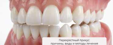 Перекрестный прикус: причины, виды и современные методы лечения