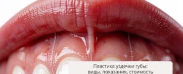 Пластика уздечки губы: виды, показания, стоимость