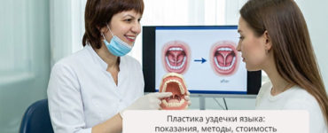 Пластика уздечки языка: показания, методы, стоимость