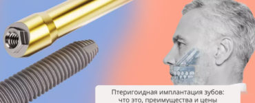 Птеригоидная имплантация зубов: что это, преимущества метода и цены
