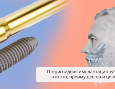 Птеригоидная имплантация зубов: что это, преимущества метода и цены