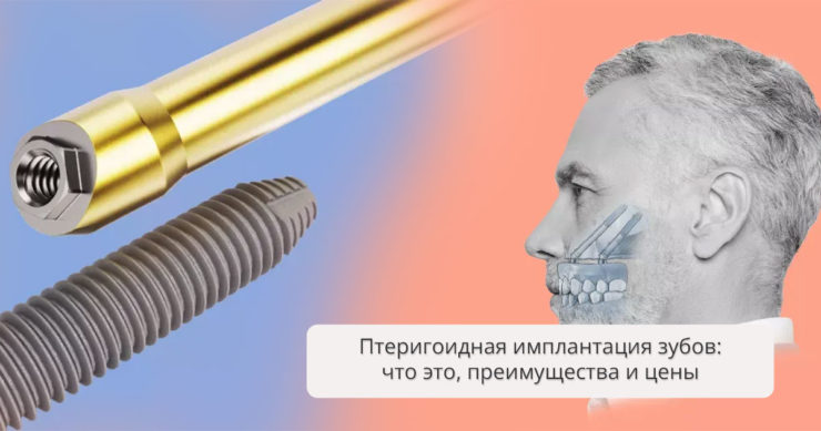 Птеригоидная имплантация зубов: что это, преимущества метода и цены