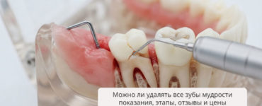 Можно ли удалять все зубы мудрости: показания, этапы, отзывы и цены