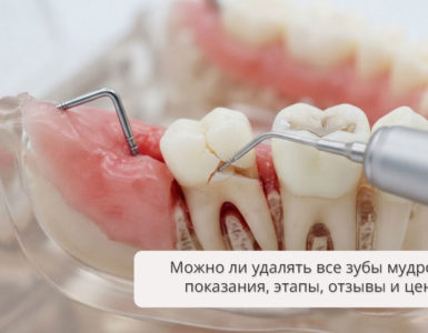 Можно ли удалять все зубы мудрости: показания, этапы, отзывы и цены
