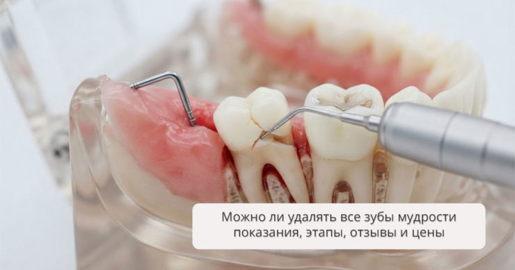 Можно ли удалять все зубы мудрости: показания, этапы, отзывы и цены