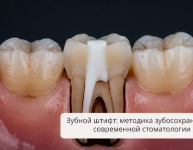 Зубной штифт: методика зубосохранения в современной стоматологии