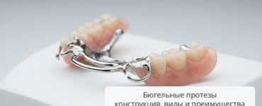 Бюгельные протезы: конструкция, виды и клинические преимущества