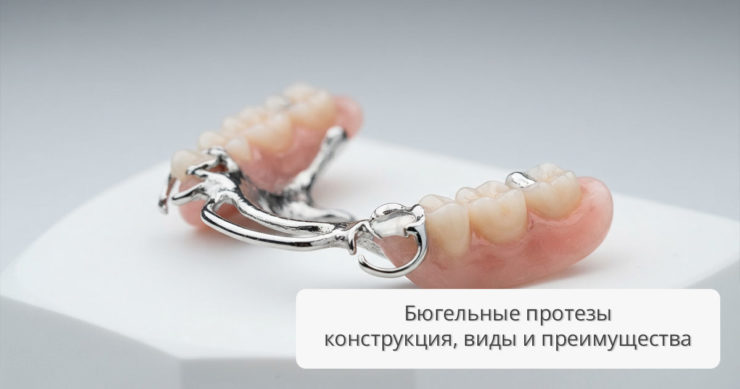 Бюгельные протезы: конструкция, виды и клинические преимущества