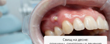 Свищ на десне: причины, симптомы и современные методы лечения