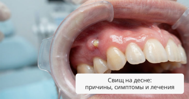 Свищ на десне: причины, симптомы и современные методы лечения