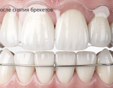 Зубы после брекетов: как защитить и избежать осложнений